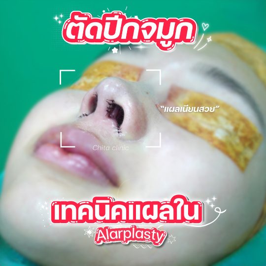 ตัดปีกจมูกใบเฟิร์น