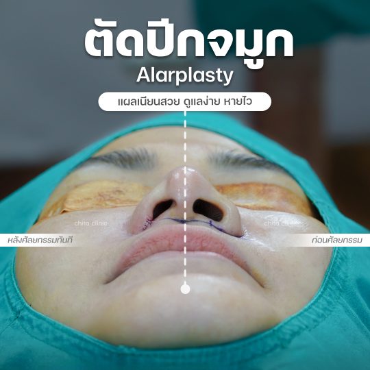 ตัดปีกจมูก